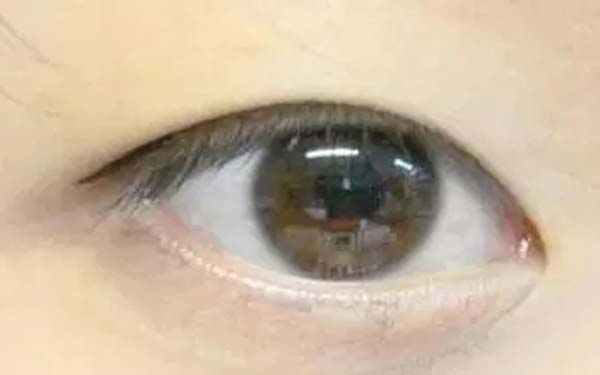 徐占峰醫(yī)師在深圳鵬愛醫(yī)院進行雙眼皮手術的效果如何？