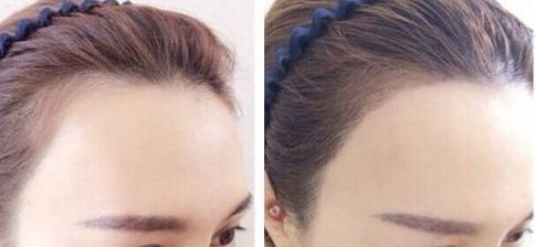杭州疤痕整形哪家醫(yī)院好？選擇哪個醫(yī)院更靠譜？