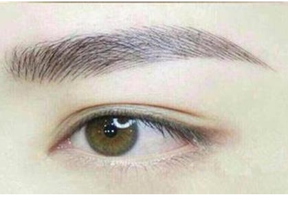 南京劉育鳳雙眼皮修復(fù)案例解析，效果如何？