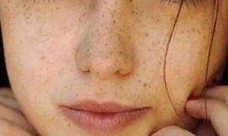 重慶當代整形美容醫(yī)院吳玉娟祛痘嫩膚效果如何