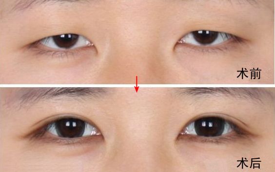 南京哪家醫(yī)院去眼袋好？眼袋手術(shù)選哪家醫(yī)院最好