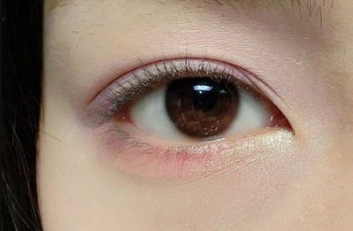 王世虎拉皮和脂肪填充的效果如何？有哪些多樣化的項目值得選擇？技術是否可靠可證？