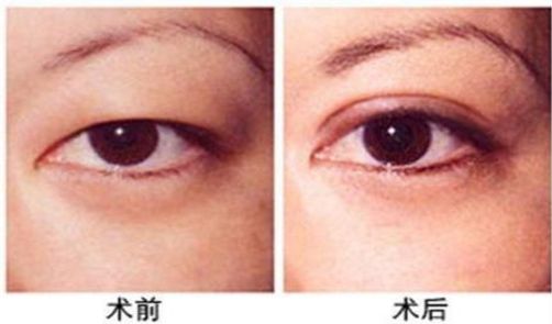 杭州做激光眼科手術哪家醫(yī)院好，專家推薦