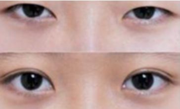 秦皇島雙眼皮哪家做的好？選擇前必看！