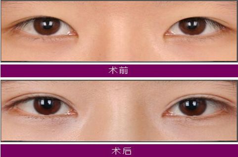 大連注射玻尿酸哪家醫(yī)院技術(shù)好，效果持久？