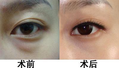 深圳雙眼皮修復，誰是比較好的醫(yī)生？實力對比胡華新、李天石、白曉東等5位專家