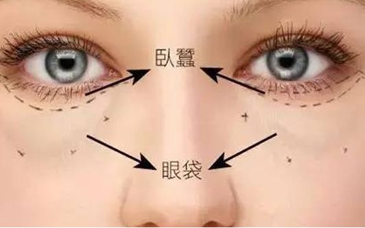 ?？谀募裔t(yī)院做眼袋效果好？