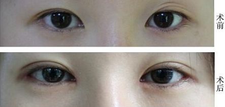 福州抽脂大腿哪家醫(yī)院好？挑選福州最靠譜的抽脂醫(yī)院有哪些？