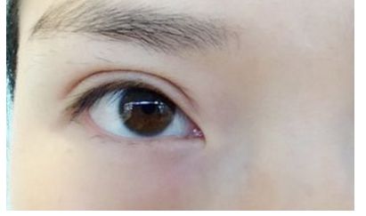 南昌祛痘哪家醫(yī)院口碑好，效果最佳？