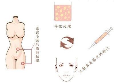 廣州燒傷疤痕治療哪家醫(yī)院效果好，選擇哪家醫(yī)院最靠譜？