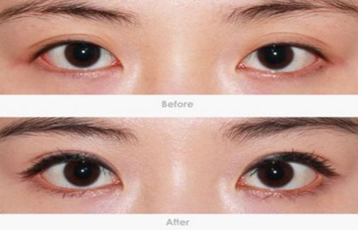 柳州哪家醫(yī)院做疤痕切除好？-獨家分享柳州疤痕切除醫(yī)院排行榜