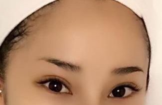 合肥哪家醫(yī)院臉部激光治療效果好，值得推薦？