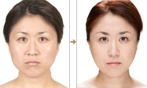 杭州整形醫(yī)院的抽脂效果如何？哪家醫(yī)院抽脂好？