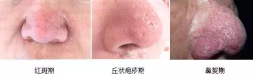 解密楊杰雙眼皮修復(fù)失敗案例圖，讓你心中的期望成為現(xiàn)實(shí)！