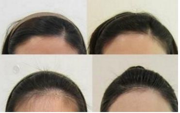 哈爾濱皮秒手術(shù)哪家醫(yī)院好？全面評測哈爾濱皮秒醫(yī)院排名