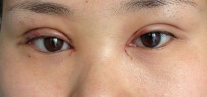 沈陽哪家醫(yī)院疤痕手術(shù)效果好？