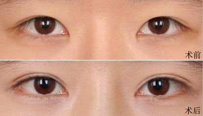 大連假體隆鼻哪家醫(yī)院好？打造完美鼻型，這家醫(yī)院是最佳選擇！