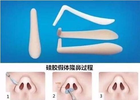 北京哪家醫(yī)院祛除眼袋效果最好？