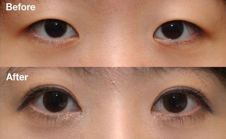 杭州雙眼皮醫(yī)院排名Top1，哪家醫(yī)院做雙眼皮效果好？