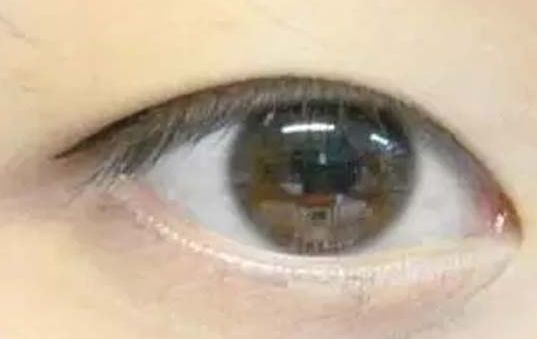 揭曉2023年武漢哪家醫(yī)院割雙眼皮好，專家推薦及真實案例！