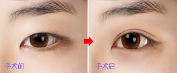 上海玻尿酸豐唇哪家醫(yī)院好？挑選上海口碑好的玻尿酸豐唇醫(yī)院