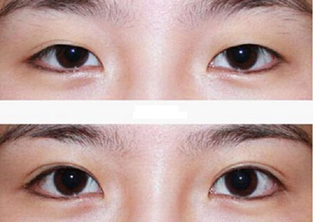 【2023年蘭州歪脖子手術(shù)哪家好？專家推薦+真實(shí)案例分析】