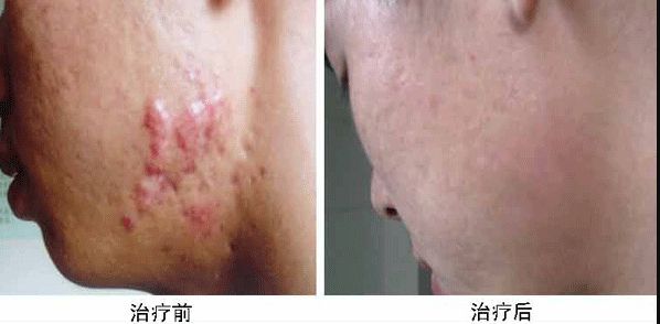 深圳哪家醫(yī)院隆胸效果好，費用適中？