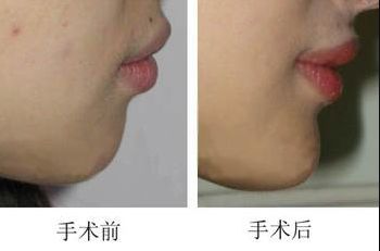 昆明哪家醫(yī)院做上臉下垂手術(shù)好，醫(yī)生技術(shù)靠譜？