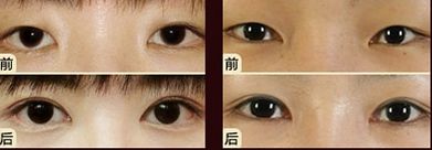 嘟嘟唇無錫哪家醫(yī)院好？專家推薦無錫哪家醫(yī)院治療嘟嘟唇好
