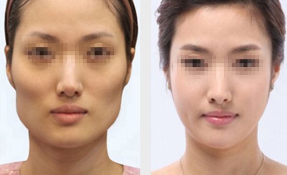 長春雙眼皮修復好的醫(yī)院有哪些？