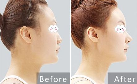 貴陽治療痘坑哪家醫(yī)院專業(yè)可靠？