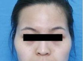 成都治療臉上痘痘哪家醫(yī)院好？專家推薦的成都治痘好醫(yī)院大揭秘！