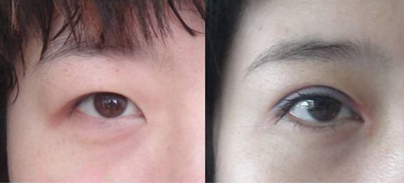 上海市激光修復(fù)痘坑效果如何？哪家醫(yī)院技術(shù)更好？