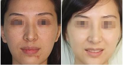 沈陽眼袋整形哪家醫(yī)院好？