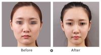 矯正牙齒需預(yù)估費(fèi)用？費(fèi)用注意事項(xiàng)解析！
