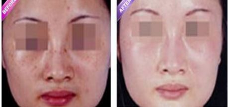 激光縮陰是否會(huì)導(dǎo)致副作用？找到安全有效的解決方法