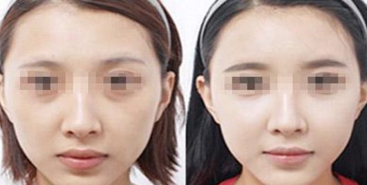 容城洗牙價(jià)格一覽，潔牙需花多少錢(qián)？