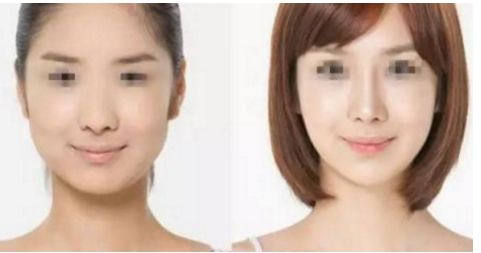 威寧隆胸手術(shù)效果如何？術(shù)后持久無需擔(dān)心！