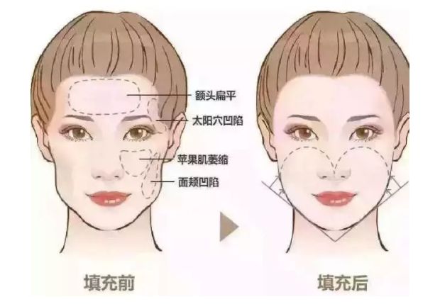 果酸療程：花多少錢一次？肌膚煥變全攻略，細節(jié)也不能忽視！