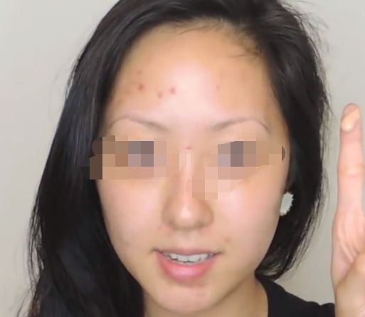 延長透明質(zhì)酸隆鼻效果，多種小竅門讓您保持完美鼻形