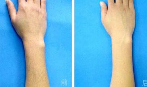 腹部吸脂手術(shù)是否存在副作用？