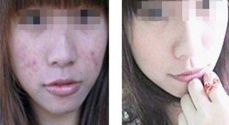 危害程度如何？全方位解析臉部拉皮手術(shù)風(fēng)險(xiǎn)與安全
