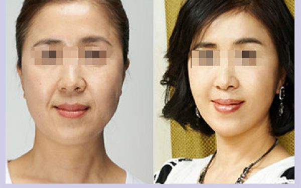 了解烤瓷牙材料，探究?jī)r(jià)格背后的價(jià)值點(diǎn)！