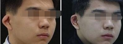 有效解決雙眼皮修復(fù)，手術(shù)方法和時間探究