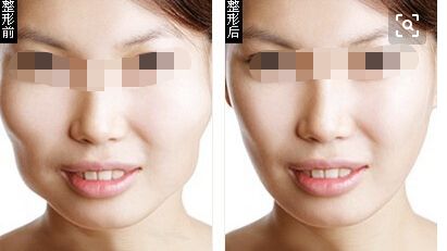 假體隆胸植入多久需要更換？