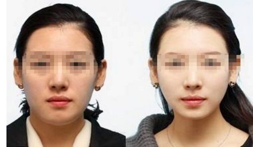 彩光嫩膚：一個療程要多少次才有效？