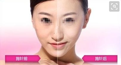 耳朵重塑技術(shù)是否優(yōu)質(zhì)？整形手術(shù)費(fèi)用如何評(píng)估？