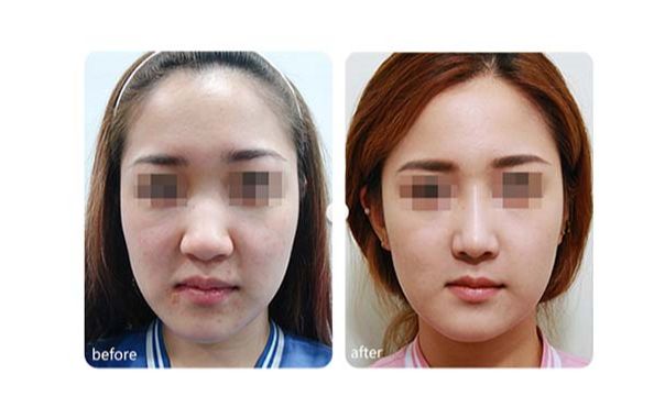 7d聚拉提果真的那么神奇嗎？挽救肌膚年齡，還讓你重獲青春之美！