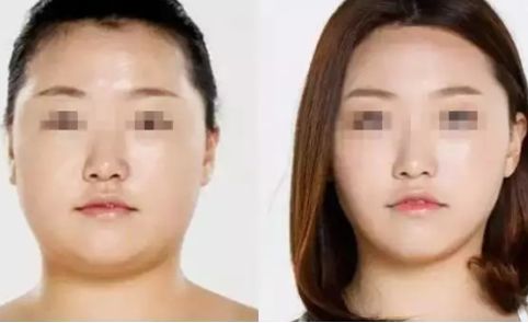 如何瘦腿？吸脂還是塑形？方法對比與價格解析