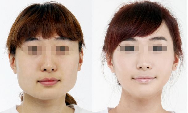 陰道緊縮術效果續(xù)續(xù)如何？術后體驗分享